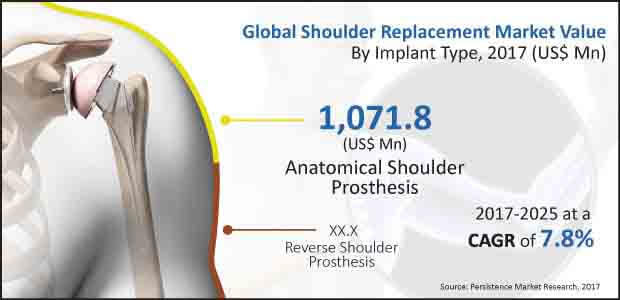 shoulder replacement market